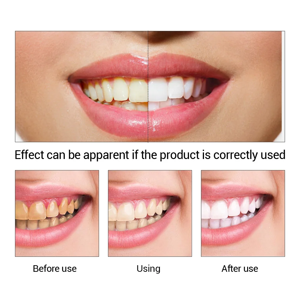 FTEENPLY Teeth Whitening Essen - Teeth Whitening Near Me 评论和价格