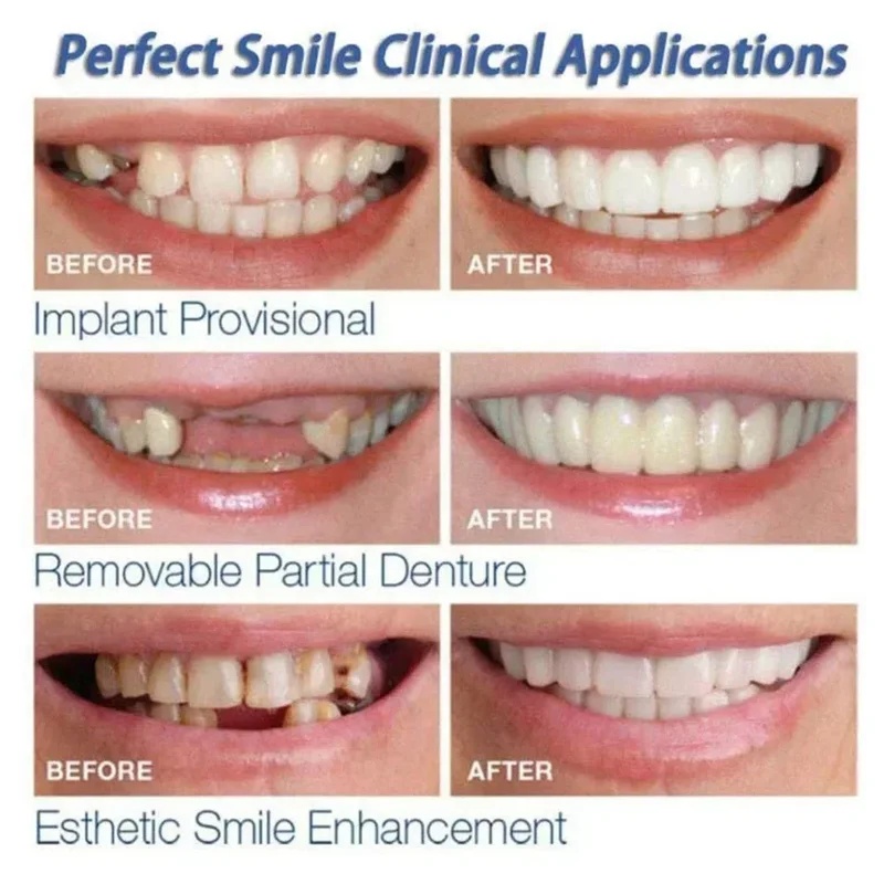 Snap-on Veneer Teeth Kit Adjus - Teeth Whitening Kit 评论和价格