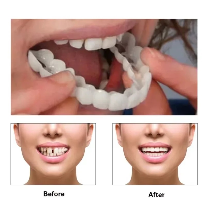 Snap-on Veneer Teeth Kit Adjus - Teeth Whitening Kit 评论和价格